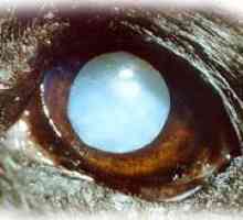 आँखों की बीमारियां: मोतियाबिंद